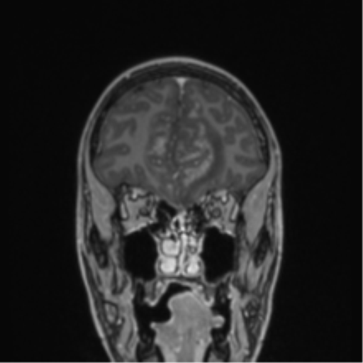 Acute disseminated encephalomyelitis (ADEM) (Radiopaedia 65319-74349 Coronal T1 C+ 51).png