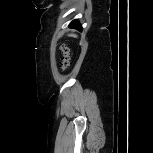 Acute diverticulitis - transverse colon (Radiopaedia 87063-103327 Sagittal C+ portal venous phase 189).jpg