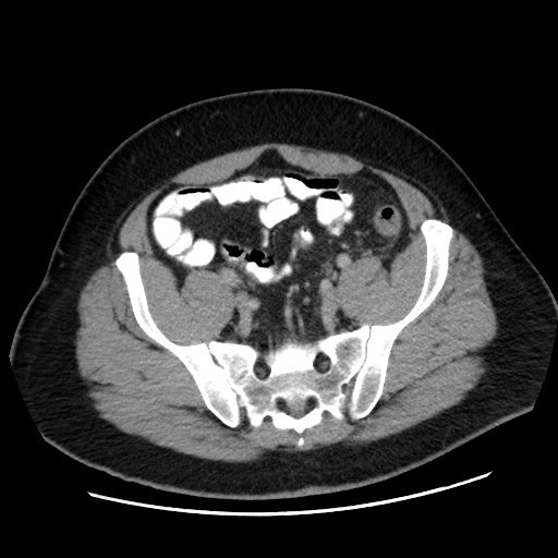 Acute diverticulitis with localized perforation (Radiopaedia 41296-44113 Axial C+ portal venous phase 70).jpg