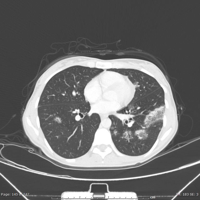 Acute eosinophilic pneumonia (Radiopaedia 48211-53073 Axial lung window 52).jpg