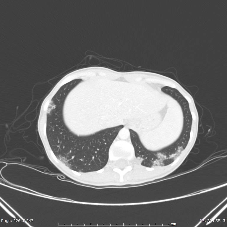 Acute eosinophilic pneumonia (Radiopaedia 48211-53073 Axial lung window 81).jpg