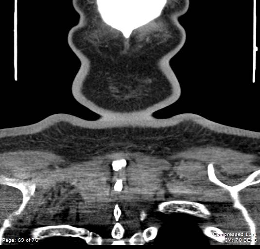 Acute epiglottitis (Radiopaedia 54375-60590 Coronal C+ arterial phase 69).jpg