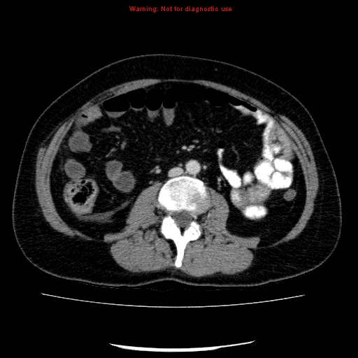 File:Acute gangrenous cholecystitis (Radiopaedia 10123-10661 Axial C+ portal venous phase 57).jpg