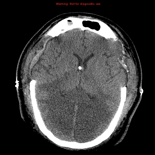 Acute hemorrhagic leukoencephalitis (Radiopaedia 14076-43697 Axial non-contrast 26).jpg