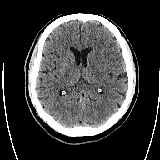 Acute left middle cerebral artery territory ischemic stroke (Radiopaedia 35688-37223 Axial non-contrast 42).png