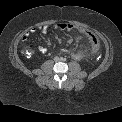 Acute mesenteric venous ischemia (Radiopaedia 46041-50383 Axial C+ portal venous phase 73).jpg