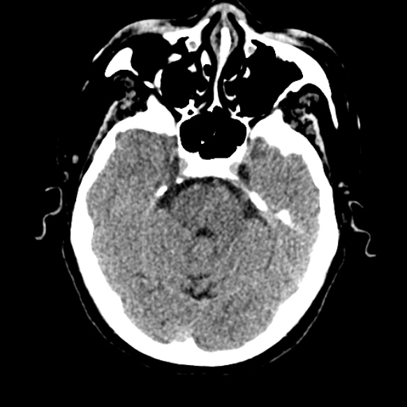 Acute middle cerebral artery territory infarct (Radiopaedia 52380-58283 Axial non-contrast 28).jpg