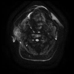 Acute otitis externa (Radiopaedia 57296-64236 Axial DWI 14).jpg
