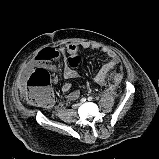 File:Acute pancreatic necrosis (Radiopaedia 13560-18501 Axial C+ portal venous phase 98).jpg