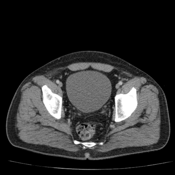 Acute pancreatitis (Radiopaedia 26663-26813 Axial C+ portal venous phase 78).jpg