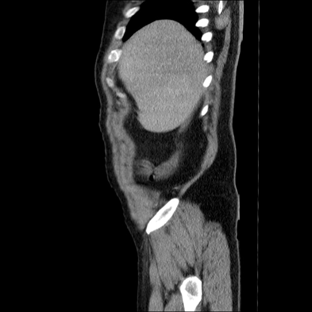 Acute pancreatitis (Radiopaedia 26663-26813 Sagittal C+ portal venous phase 10).jpg