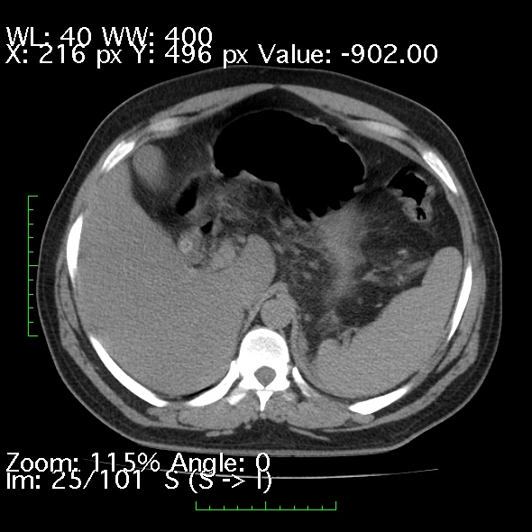 Acute pancreatitis (Radiopaedia 34043-35276 Axial non-contrast 25).jpg