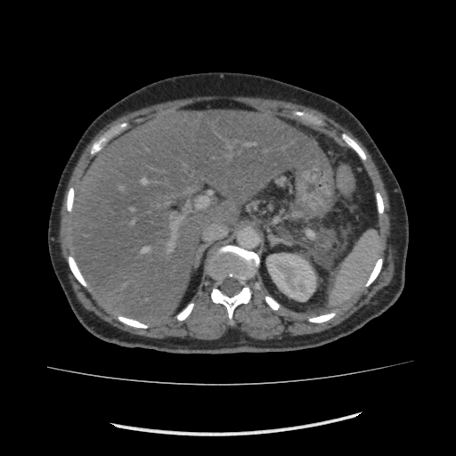 Acute pancreatitis (Radiopaedia 80007-93285 Axial C+ portal venous phase 31).jpg