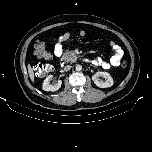 File:Acute pancreatitis (Radiopaedia 85390-101010 Axial C+ portal venous phase 45).jpg