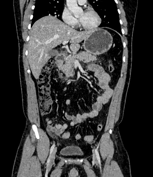 Acute pancreatitis (Radiopaedia 87428-103757 Coronal C+ portal venous phase 38).jpg