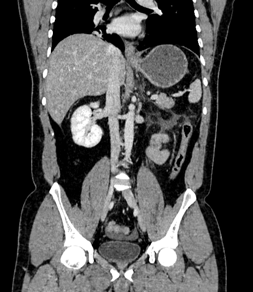 Acute pancreatitis (Radiopaedia 87428-103757 Coronal C+ portal venous phase 52).jpg