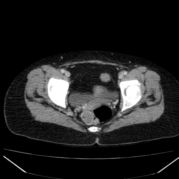 Acute pancreatitis - Balthazar C (Radiopaedia 26569-26714 Axial C+ portal venous phase 88).jpg