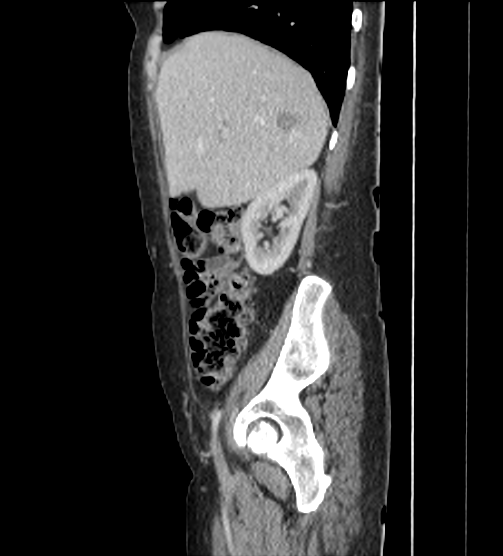 Acute pancreatitis - Balthazar E - post ERCP (Radiopaedia 27562-27772 Sagittal C+ portal venous phase 29).png