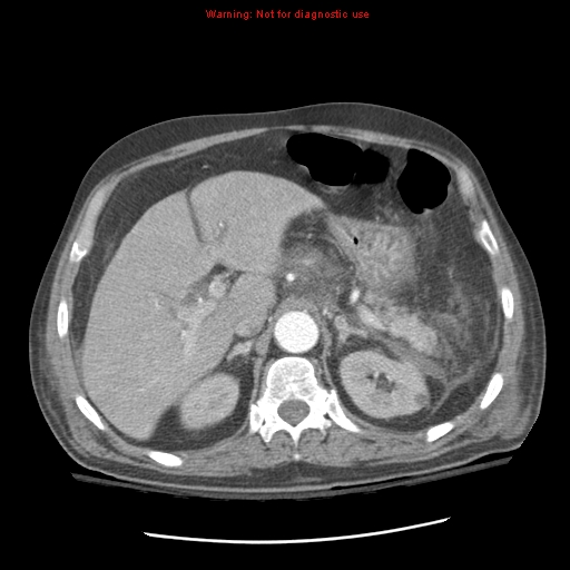 Acute pancreatitis with incidental pancreatic lipoma (Radiopaedia 10190-10730 Axial C+ arterial phase 30).jpg