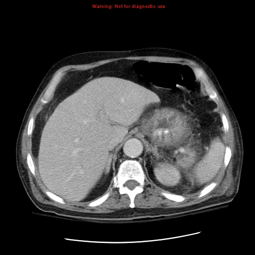 File:Acute pancreatitis with incidental pancreatic lipoma (Radiopaedia 10190-10730 Axial C+ portal venous phase 14).jpg
