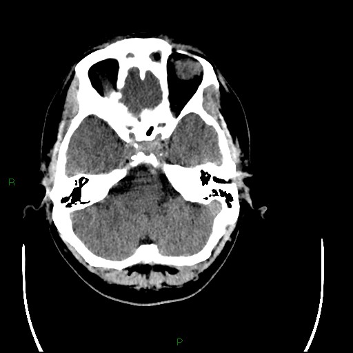 File:Acute posterior cerebral artery territory infarct (Radiopaedia 79329-92393 Axial non-contrast 24).jpg