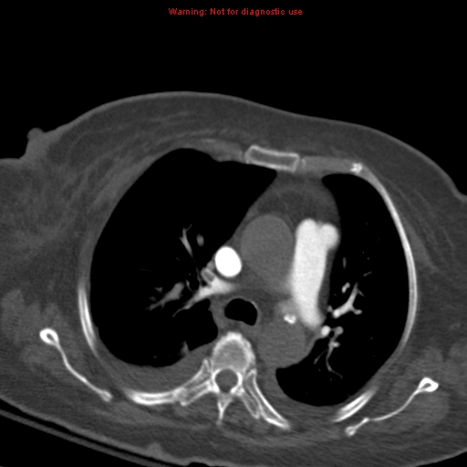 Acute pulmonary embolism (Radiopaedia 13286-13289 Axial C+ CTPA 27).jpg