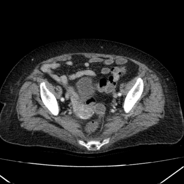 Acute pyelonephritis (Radiopaedia 26584-26729 Axial renal cortical phase 62).jpg