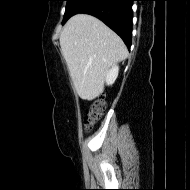 Acute pyelonephritis (Radiopaedia 33397-34434 Sagittal renal parenchymal phase 21).jpg
