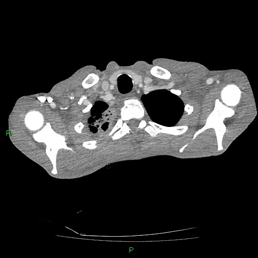 File:Acute right lung abscess (Radiopaedia 34806-36258 Axial C+ arterial phase 13).jpg