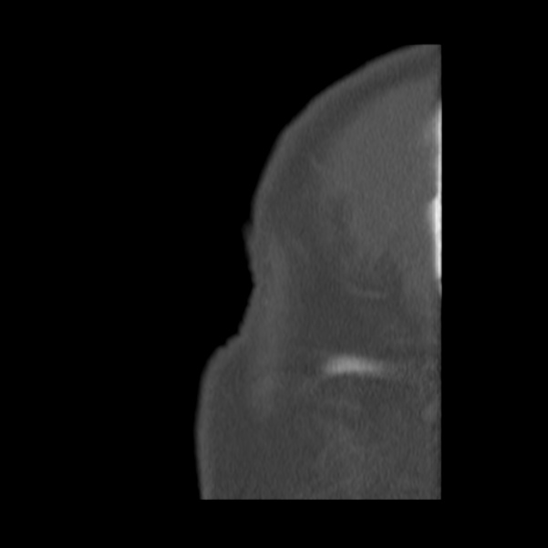 Acute sinusitis (Radiopaedia 23161-23215 Sagittal bone window 2).jpg