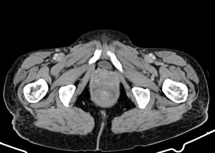 Acute small bowel (ileal) volvulus (Radiopaedia 71740-82139 Axial C+ portal venous phase 206).jpg