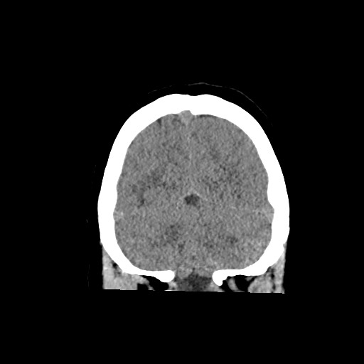 Acute subarachnoid hemorrhage and accessory anterior cerebral artery (Radiopaedia 69231-79008 Coronal non-contrast 58).jpg
