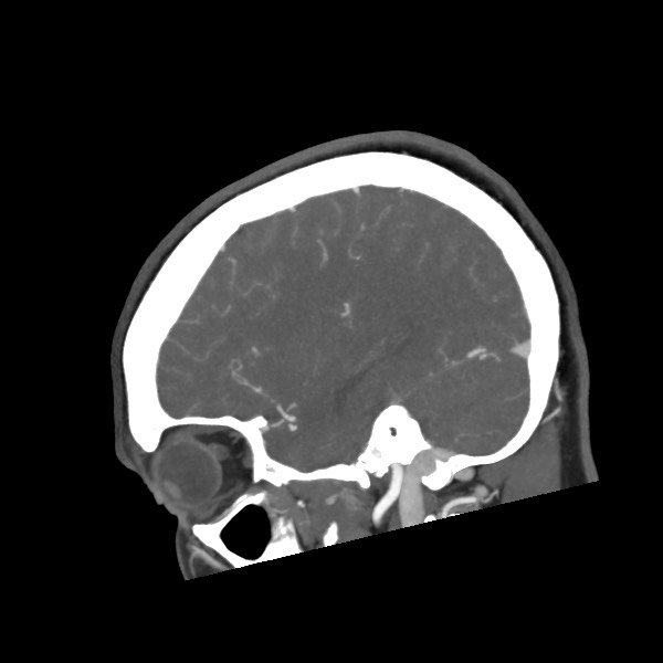 Acute subarachnoid hemorrhage and accessory anterior cerebral artery (Radiopaedia 69231-79009 Sagittal C+ arterial phase 52).jpg