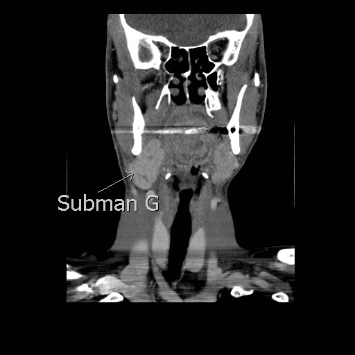 File:Acute submandibular sialadenitis secondary to ductal stone (Radiopaedia 27999-28267 D 1).jpg