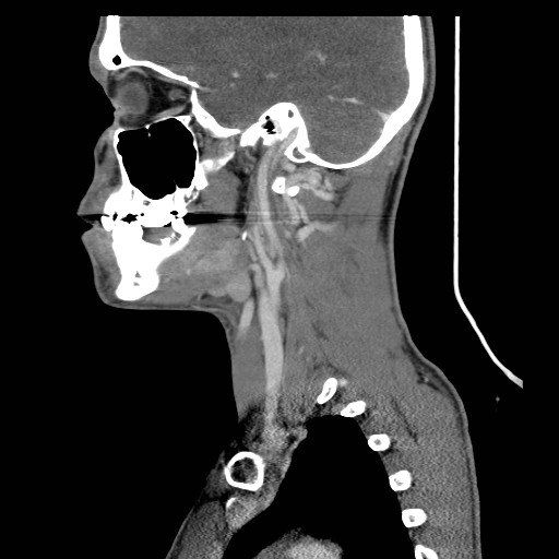 File:Acute submandibular sialadenitis secondary to ductal stone (Radiopaedia 27999-28267 Sagittal C+ delayed 31).jpg