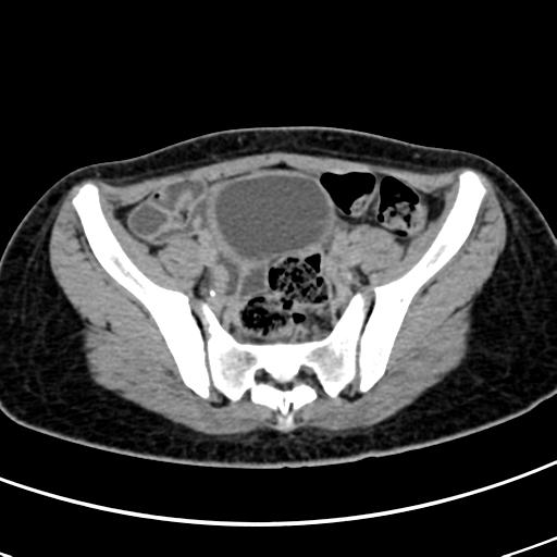 File:Acute suppurative pyelonephritis (Radiopaedia 18306-18147 Axial renal excretory phase 131).jpg