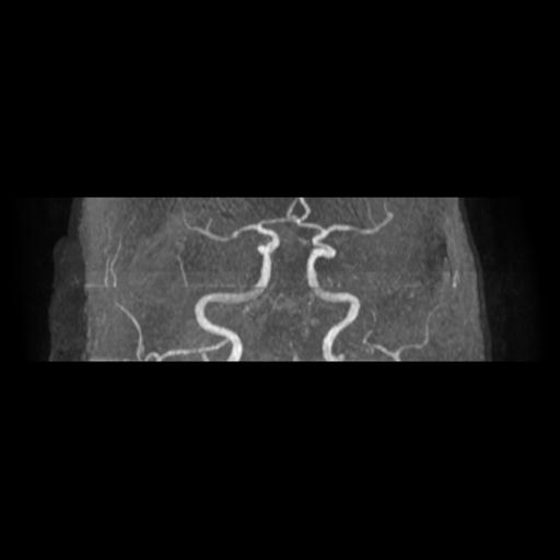 File:Acute vertebrobasilar ischemic infarction (Radiopaedia 25220-25474 Axial MRA 13).jpg