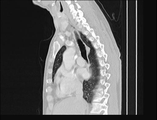 Addison disease (Radiopaedia 49318-54412 Sagittal lung window 36).jpg