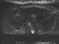 Adenocarcioma of rectum- T1 lesion (Radiopaedia 36921-38546 Axial DWI 18).png