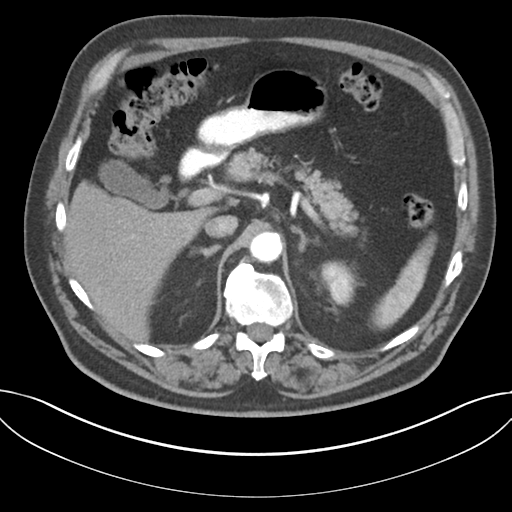 Adenocarcioma of rectum- T1 lesion (Radiopaedia 36921-38547 Axial C+ arterial phase 58).png