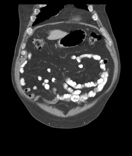 Adenocarcioma of rectum- T1 lesion (Radiopaedia 36921-38547 Coronal C+ portal venous phase 14).png
