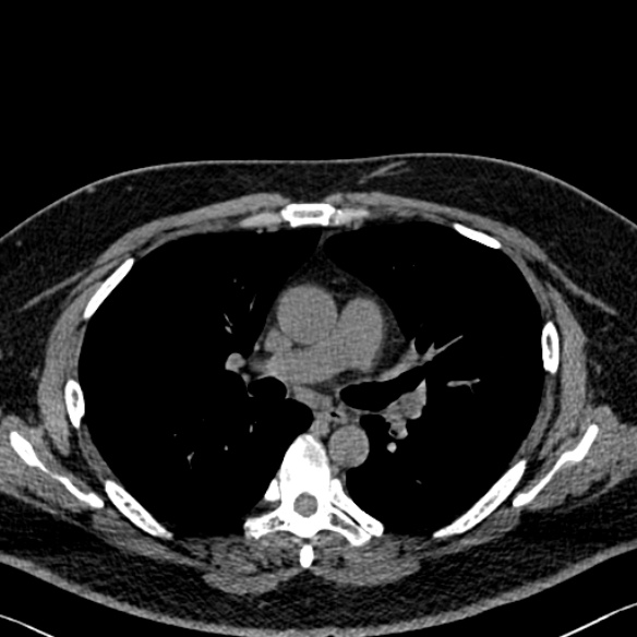 Adenoid cystic carcinoma of the trachea (Radiopaedia 49042-54137 Axial non-contrast 152).jpg