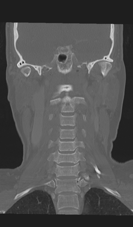 Adenoid cystic tumor of palate (Radiopaedia 46980-51518 Coronal bone window 38).png