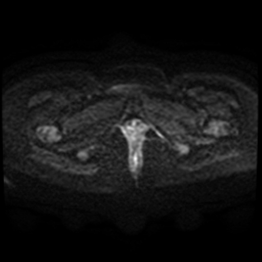 Adenoma malignum of cervix (Radiopaedia 66441-75705 Axial DWI 100).jpg