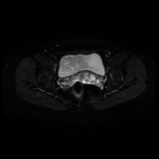 Adenoma malignum of cervix (Radiopaedia 66441-75705 Axial DWI 14).jpg