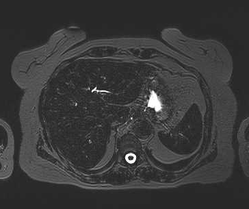 File:Adenomyomatosis of the gallbladder (Radiopaedia 50246-55587 Axial 98).png