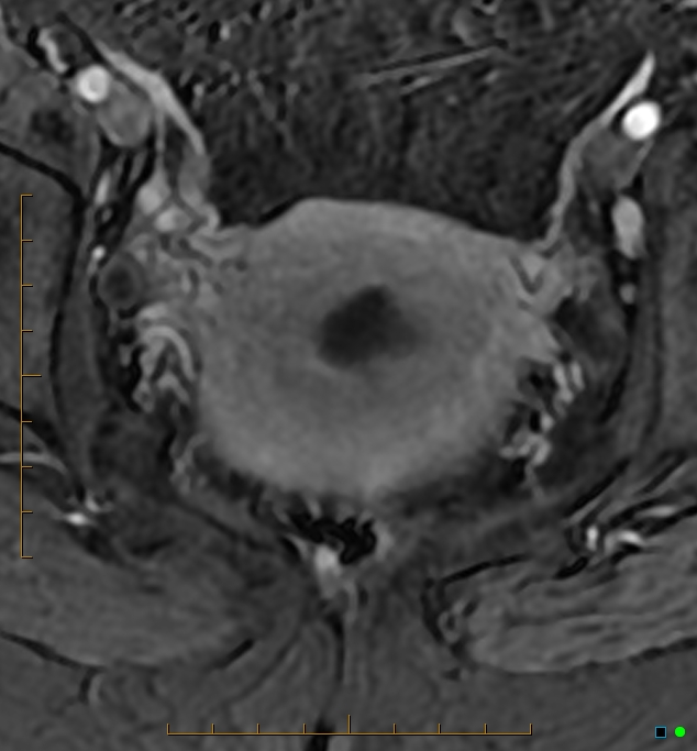 Adenomyosis uterus with hematometra (Radiopaedia 45779-50011 Axial T1 C+ fat sat 42).jpg