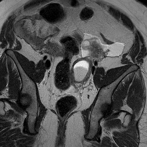 File:Adenomyosis within a didelphys uterus (Radiopaedia 70175-80215 Coronal T2 20).jpg