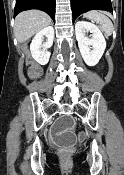 Adhesional small bowel obstruction (Radiopaedia 48397-53305 Coronal C+ portal venous phase 253).jpg