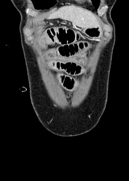 Adhesional small bowel obstruction (Radiopaedia 48397-53305 Coronal C+ portal venous phase 47).jpg